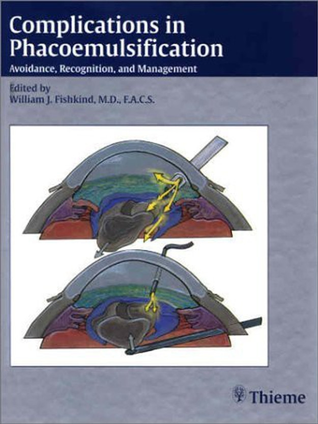 Complications in phacoemulsification : avoidance, recognition, and management